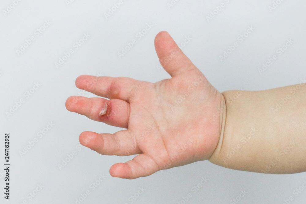 wound burn on child's hand