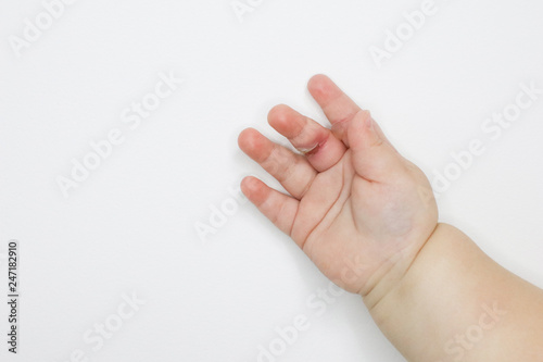 wound burn on child's hand