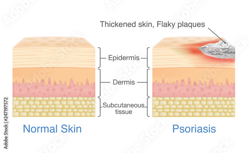 Normal skin layer and skin when plaque psoriasis signs and symptoms appear. illustration about dermatology diagram.