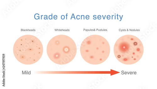 Grade of acne severity. Medical diagram about skin problems from different types acne.