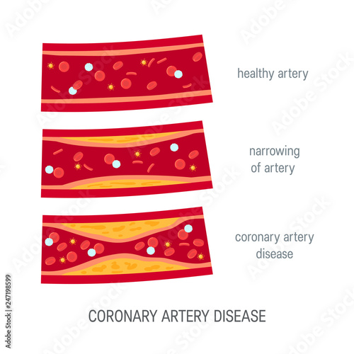 Coronary artery disease concept in flat style