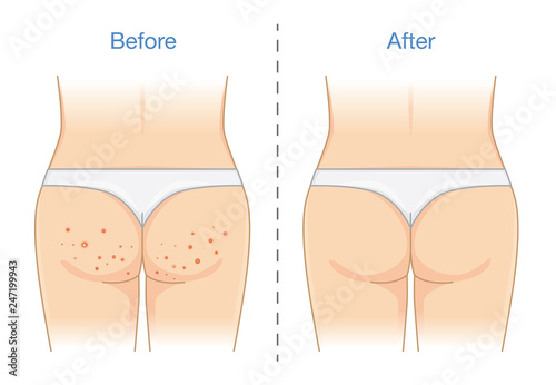 Buttocks with many pimples and after skin treatment. Illustration about health care.