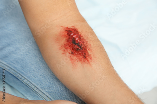 Young man with injured arm in clinic, closeup. First aid