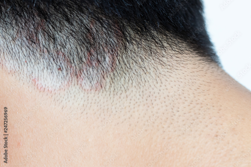 Closed up of ringworm (tinea) on head of asian man (Dermatitis) Stock ...