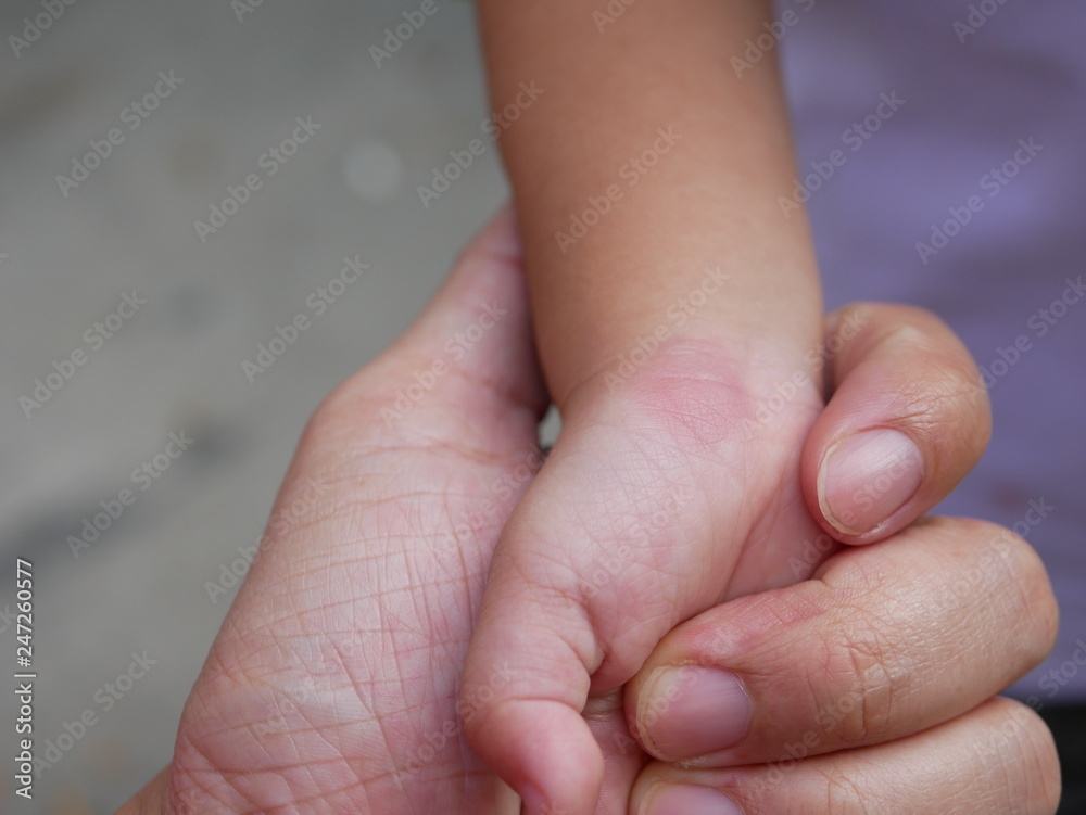 Close up of redness, itching, and swelling after a mosquito bite on a little baby's wrist - allergy to mosquito saliva in babies Close up of redness, itching, and swelling after a mosquito bite on a little baby's wrist - allergy to mosquito saliva in babies