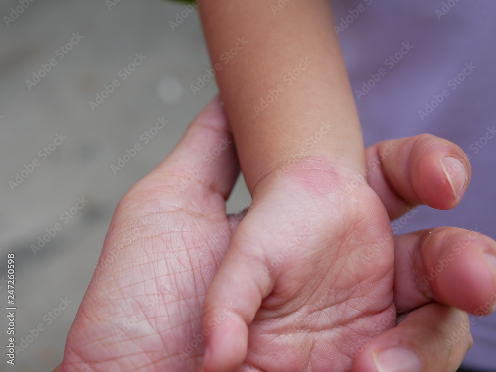 Close up of redness, itching, and swelling after a mosquito bite on a