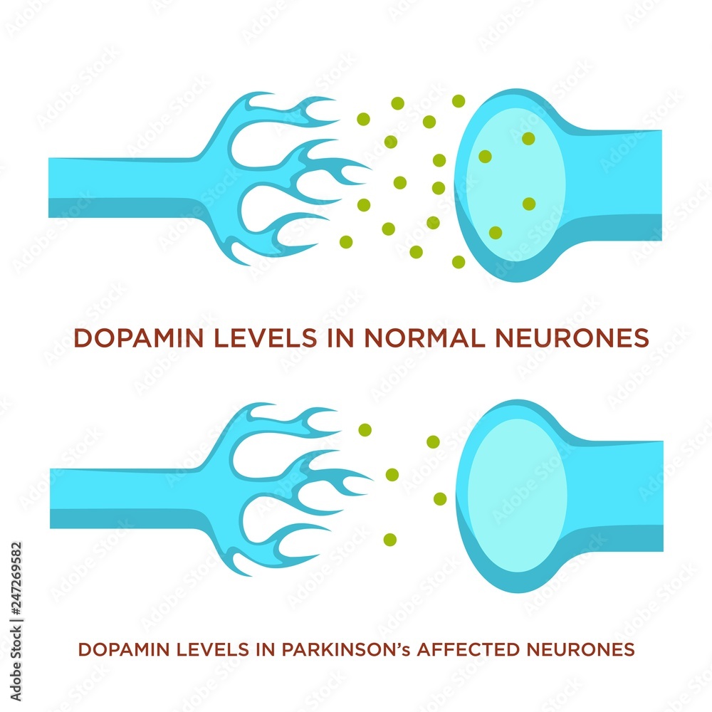 Dopamin level in normal neurones and with Parkinson disease Dopamin level in normal neurones and with Parkinson disease