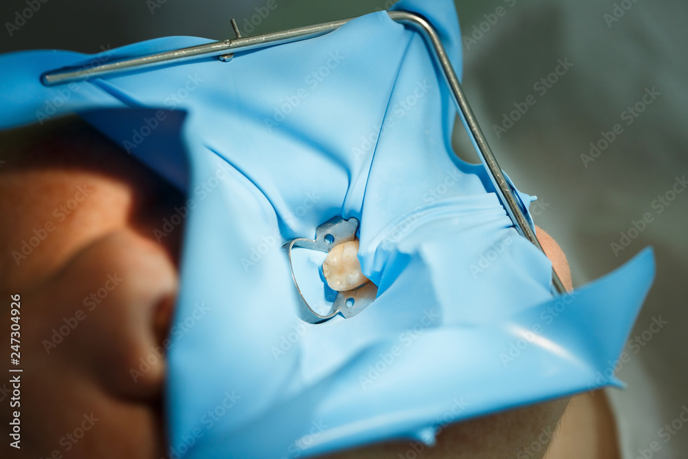 Patient getting dental treatment with smart matrix system clamp