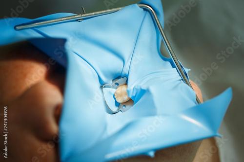 Patient getting dental treatment with smart matrix system clamp photo