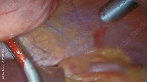 Endoscopy. Broadcast surgery to a monitor or TV screen. The internal organs of the human abdominal cavity. View through a laparoscopic video camera.