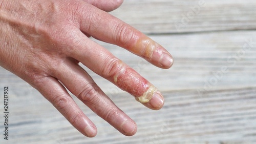 woman with a burn of the skin and fingers, injuries with boiling water, an accident at home, careless behavior with boiling water, steam, scales on the skin, an injured hand, injured fingers of a