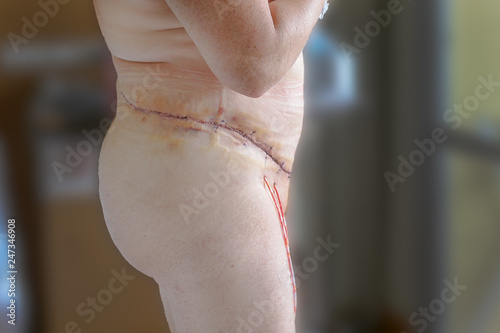 Selective focus of mature women three days post abdominoplasty, beltectomy, panniculectomy or apron removal. A tummy tuck extending round to the spine. Over 300 stitches, wound drains in situ, looking