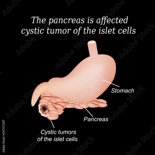 The pancreas is affected cystic tumor of the islet cells. Vector illustration on a black background