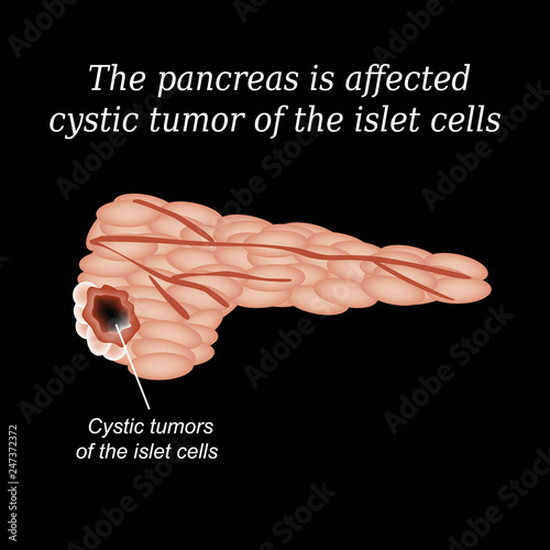 The pancreas is affected cystic tumor of the islet cells. Vector illustration on a black background