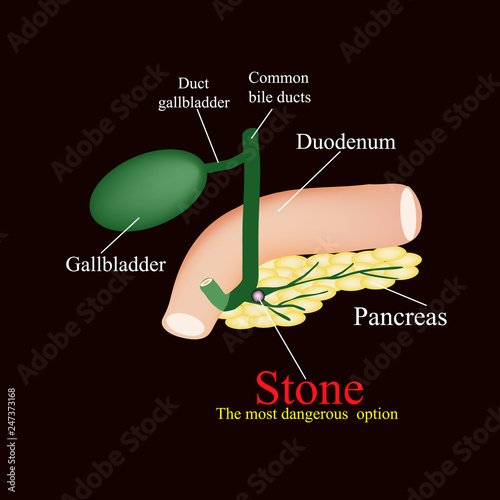 Stone pancreatic bile duct.  The gall bladder, duodenum, bile ducts. Vector illustration on a black background