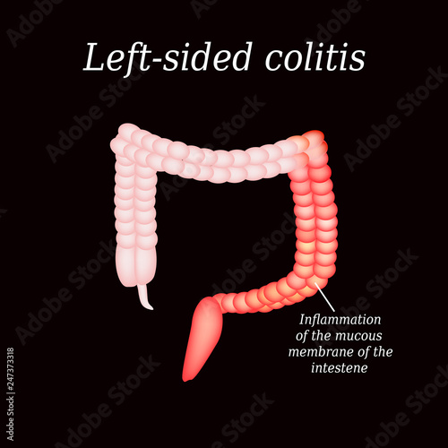 Inflammation of the large intestine divisions. Vector illustration on a black background