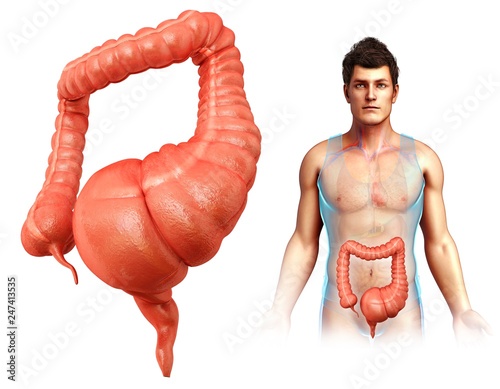 Man with mega colon, illustration