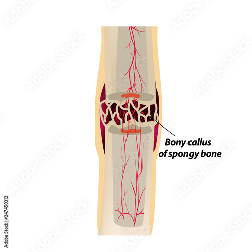 3 Stage Of Healing Bone Fracture. callus ossification. The bone fracture. Infographics. Vector illustration on isolated background.