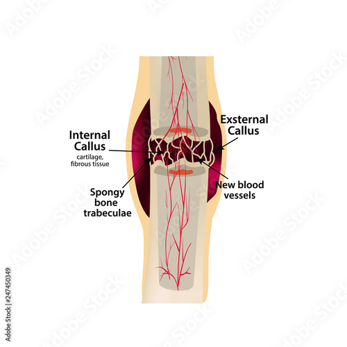 2 Stage Of Healing Bone Fracture. Formation of callus. The bone fracture. Infographics. Vector illustration on isolated background.