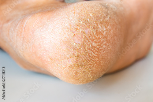 Cracked skin on heels. Dry skin of the feet.