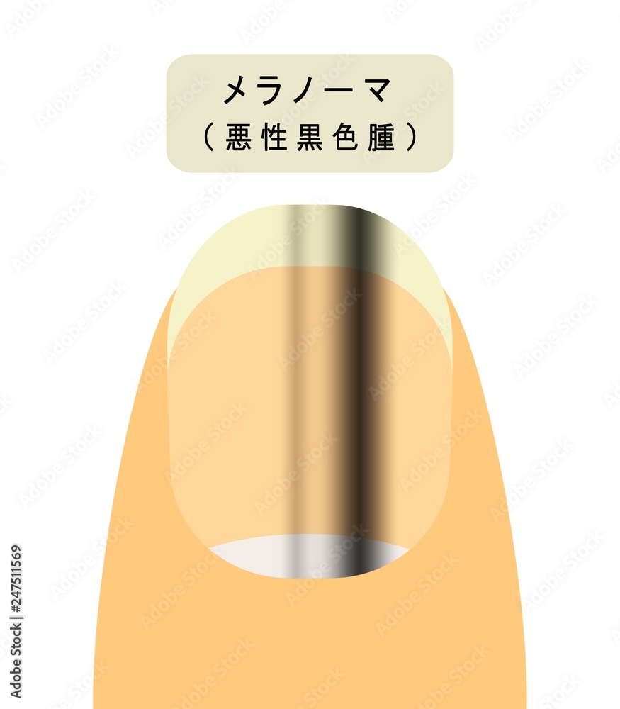 爪に出来たメラノーマ Stock Illustration Adobe Stock