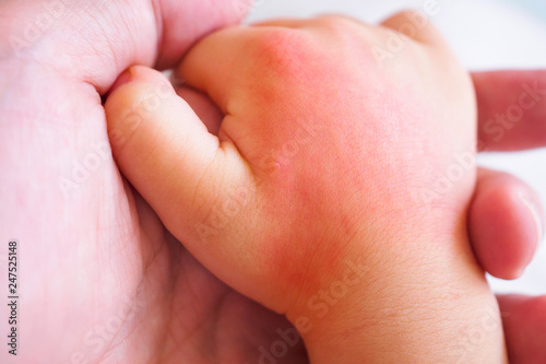 baby hand with skin rash and allergy with red spot cause by mosquito bite