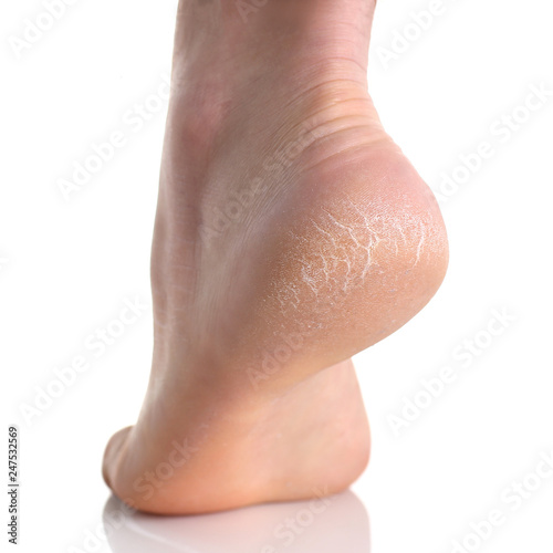 The heel of foot with bad skin covered with cracks photo