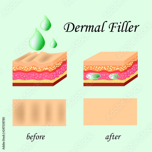Vector illustration with cosmetic filler or Dermal fillers on green background