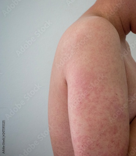 An exanthem is a rash or eruption on the skin. 