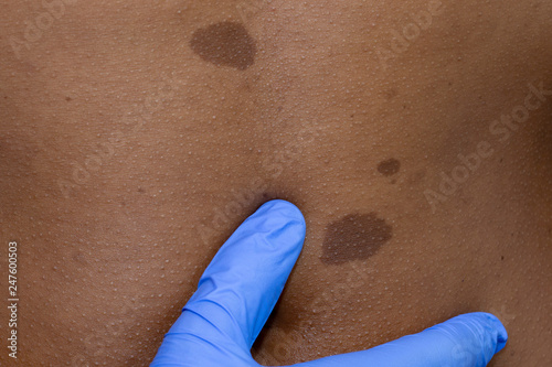 Medical dermatologist examines benign moles in African patient. photo