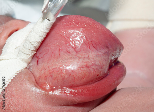 Tongue hemangioma in newborn photo