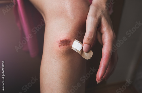 Abrasion on the woman's knee. Girl is applying antiseptic band-aid plaster on the injured leg with a red wound. Medical treatment.