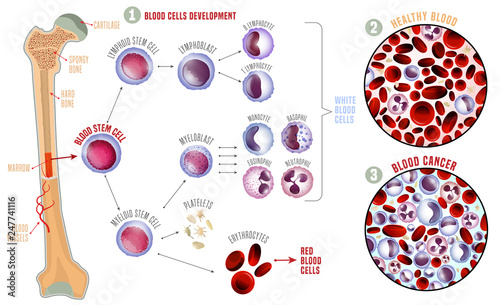 Leukemia medical infographic