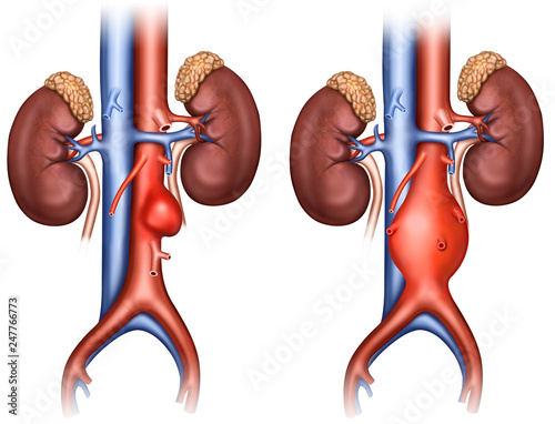 Tipos de Aneurisma abdominal photo