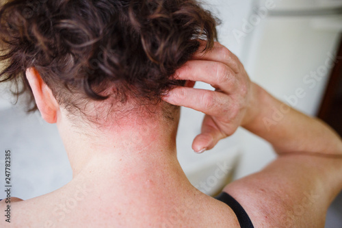 Close up view of woman scratching her neck. Allergy skin