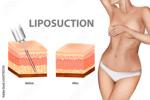 Liposuction or lipo. The Human Skin layer before lipo and after Liposuction. Plastic surgery infographic of Aesthetic Procedures
