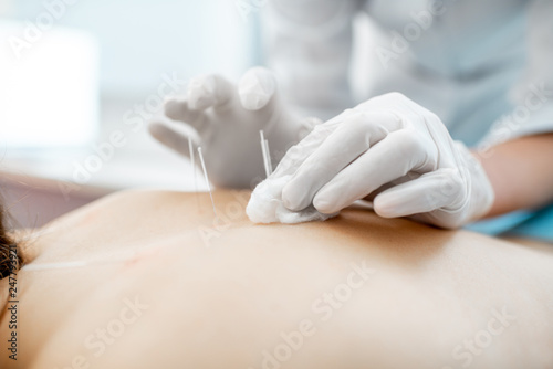 Close-up of the acupuncture medical treatment with special needles