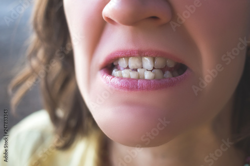 Quadro em tela Photo of crooked woman teeth