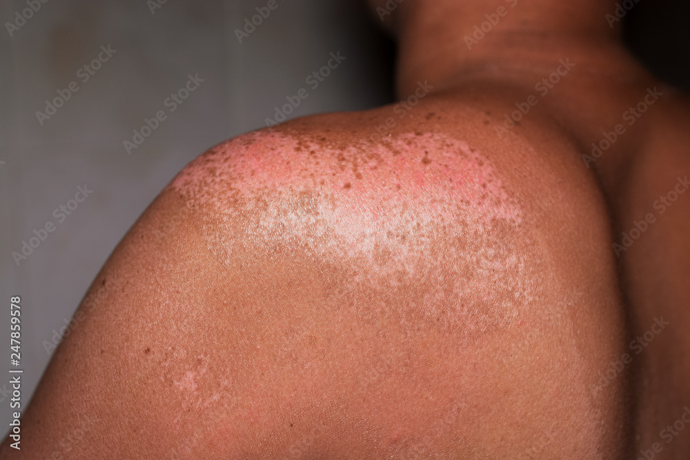 man with reddened, itchy skin after sunburn. man with reddened, itchy skin after sunburn.