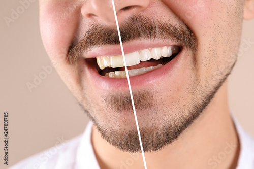 Smiling man before and after teeth whitening procedure on color background  closeup