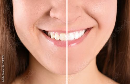Smiling young woman before and after teeth whitening procedure, closeup