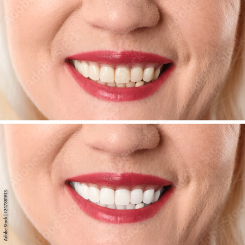 Smiling mature woman before and after teeth whitening procedure  closeup