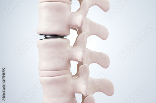 Illustration of intervertebral disc prosthesis. 3d render.