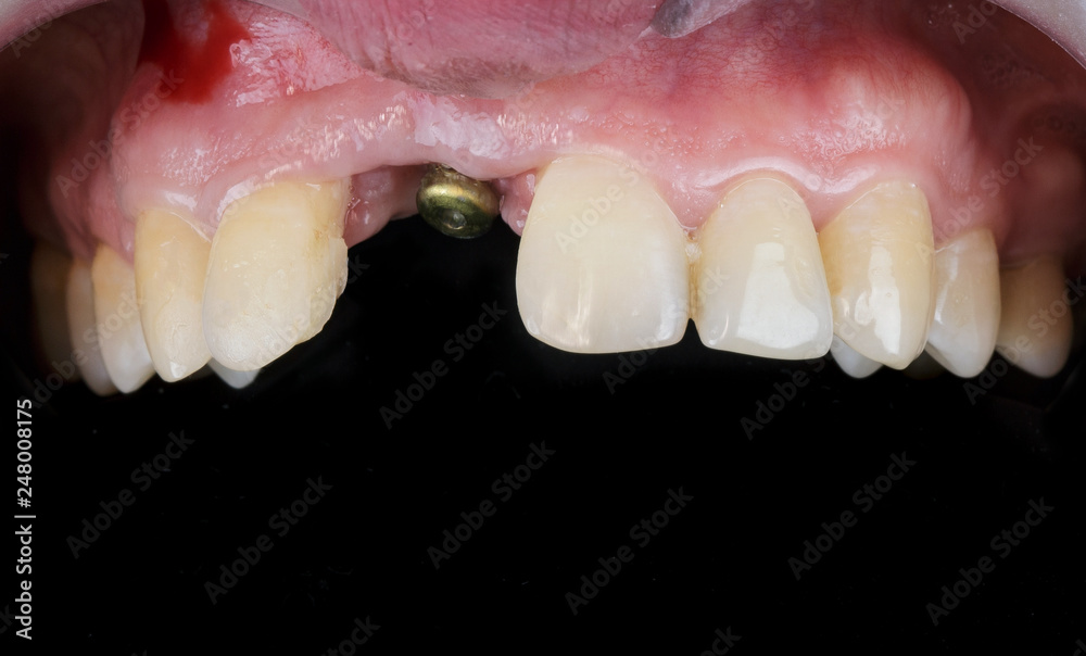 implanted place for incisor crowns and fixed gingiva shaper