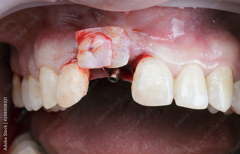soft tissue adding to the gum after implantation