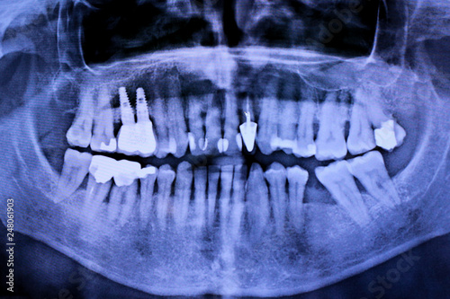 Details with a stomatological radiography (x-ray)