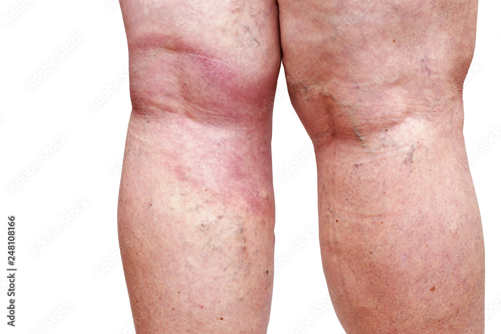 The varicose veins The varicose veins