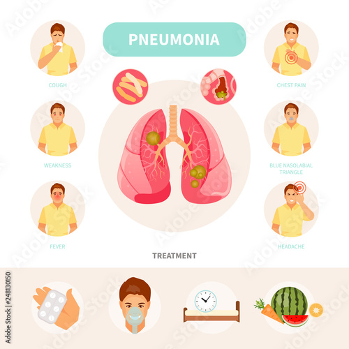 Pneumonia infographic vector