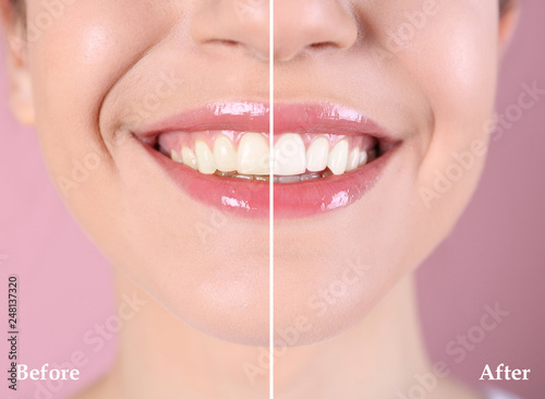 Smiling young woman before and after teeth whitening procedure on color background, closeup