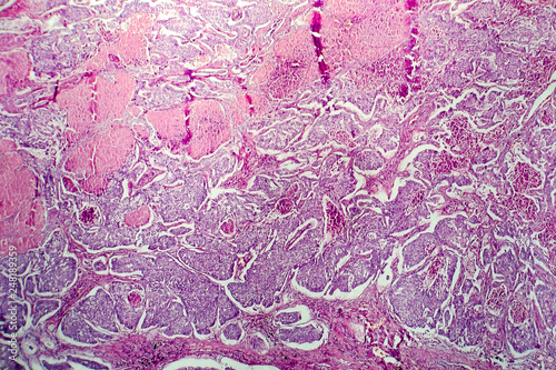 Lung adenocarcinoma  light micrograph  photo under microscope